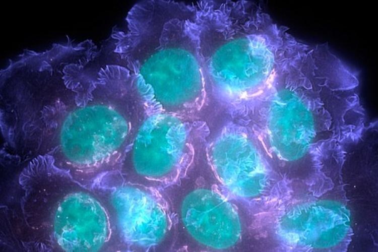 Egy daganaton belül sokféle rákos sejt lehet egy kutatás szerint